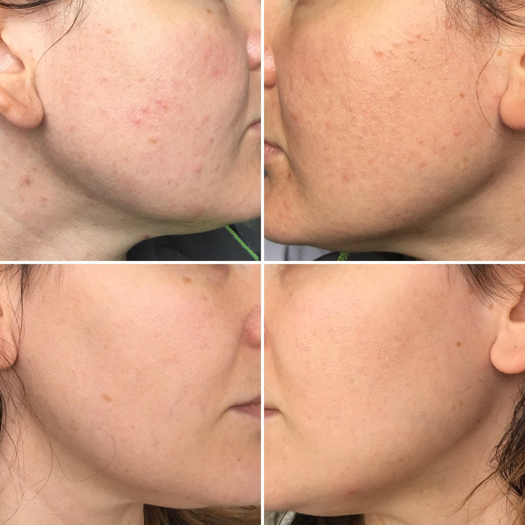 Xiangqimei Natural Exfoliating Cream Peeling Gel - Instant 30-Second Skin Renewal