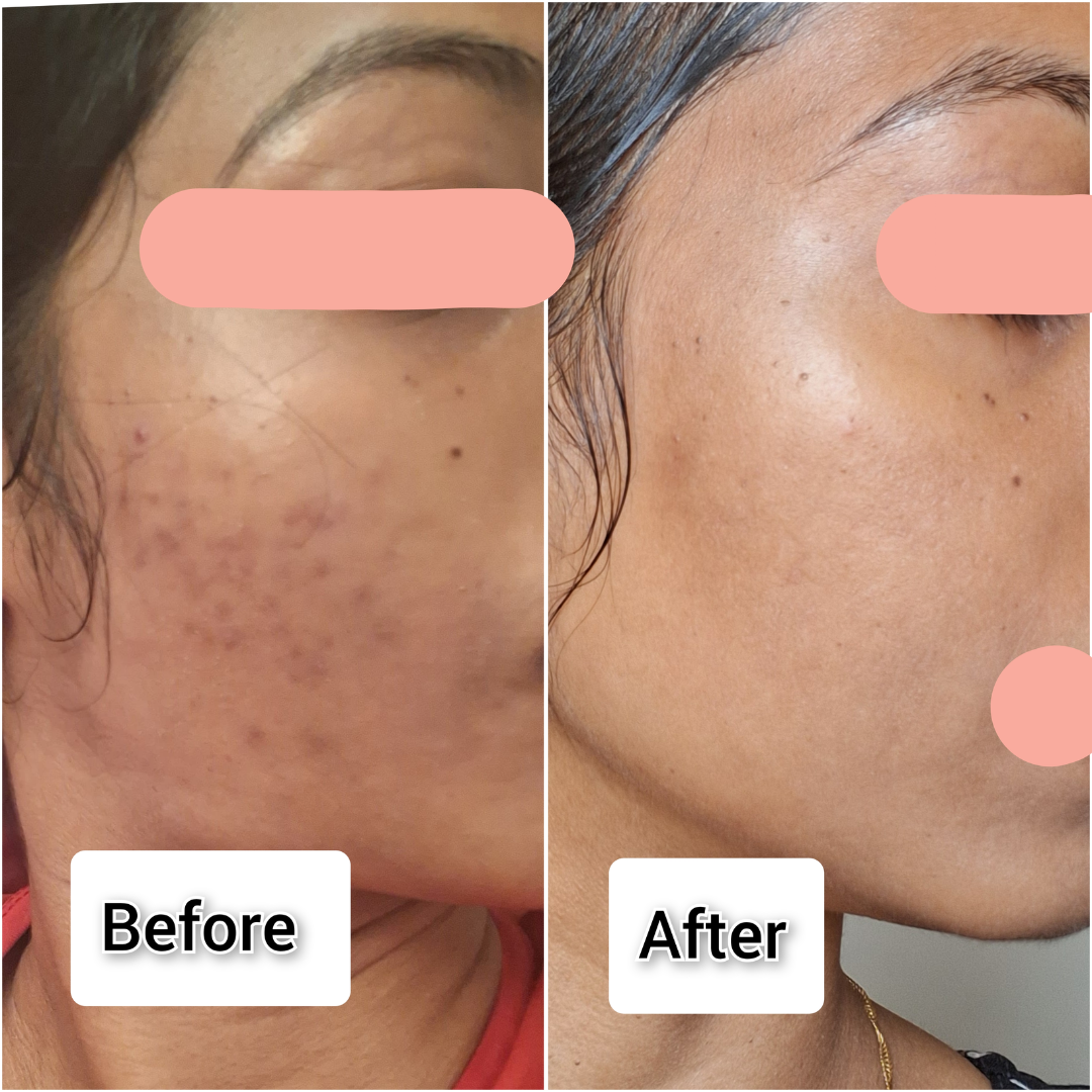 Xiangqimei Natural Exfoliating Cream Peeling Gel - Instant 30-Second Skin Renewal
