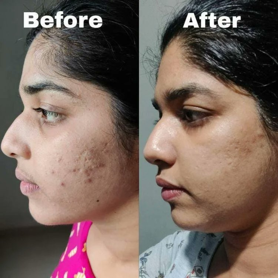 Emolene Cream 100g - Intense Moisturizer for Dry Skin, Smoothens & Helps Fade Marks & Acne Spots